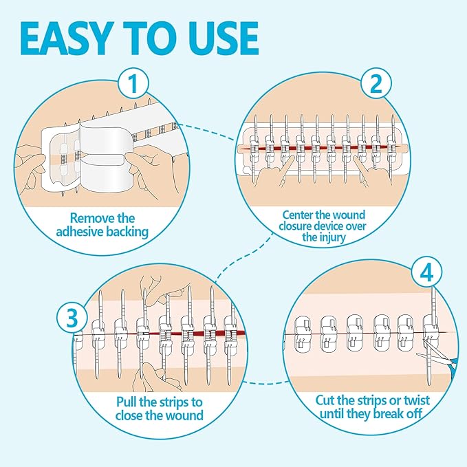 Large Butterfly Bandages for Extra Large Wounds | FSA/HSA Eligible Steri Strips Wound Closure - Surgical-Grade Stitch-Free Laceration Repair & Rapid Hemostasis, Emergency First Aid Care
